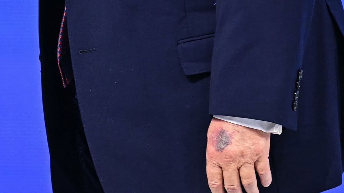 Trump explains mysterious bruise: Aspirin
