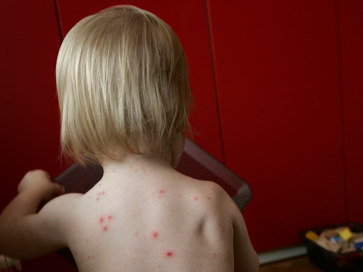 Government Plans to Add Chickenpox Vaccine to Child Vaccination Program